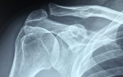 Platelet-Rich Therapy reduces re-tear rate after Rotator Cuff Repair